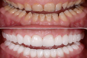 Full mouth rehabilitation in pune, Laxmi road, Camp